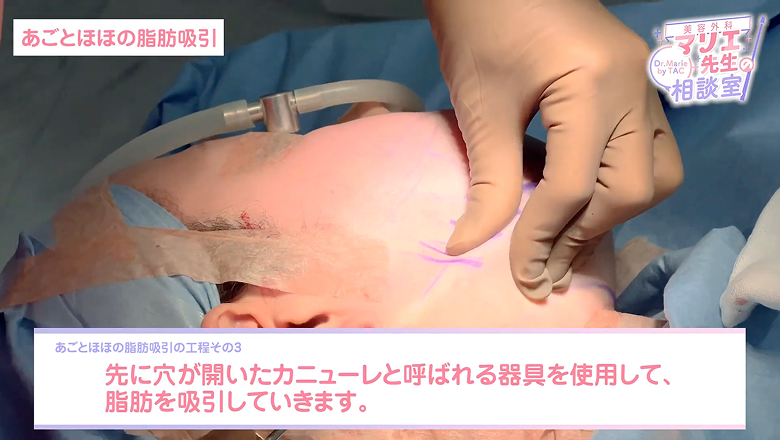 先に穴が開いたカニューレで顎下の脂肪を吸引する様子