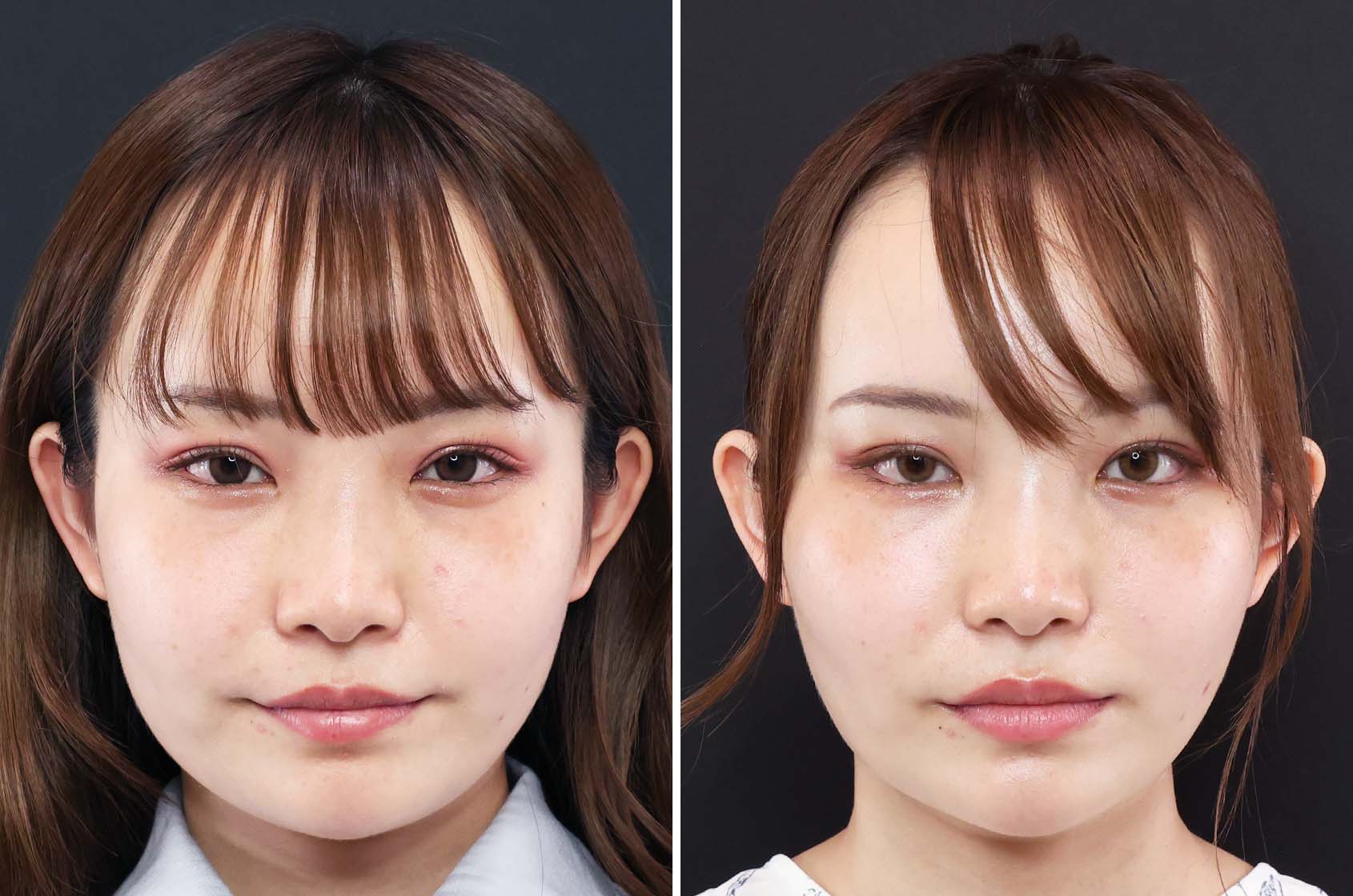 症例写真 ビフォーアフター ダウンタイム 副作用 アゴ下の脂肪吸引と糸リフトの相乗効果 Taクリニックグループ 美容整形 美容外科 全国展開中