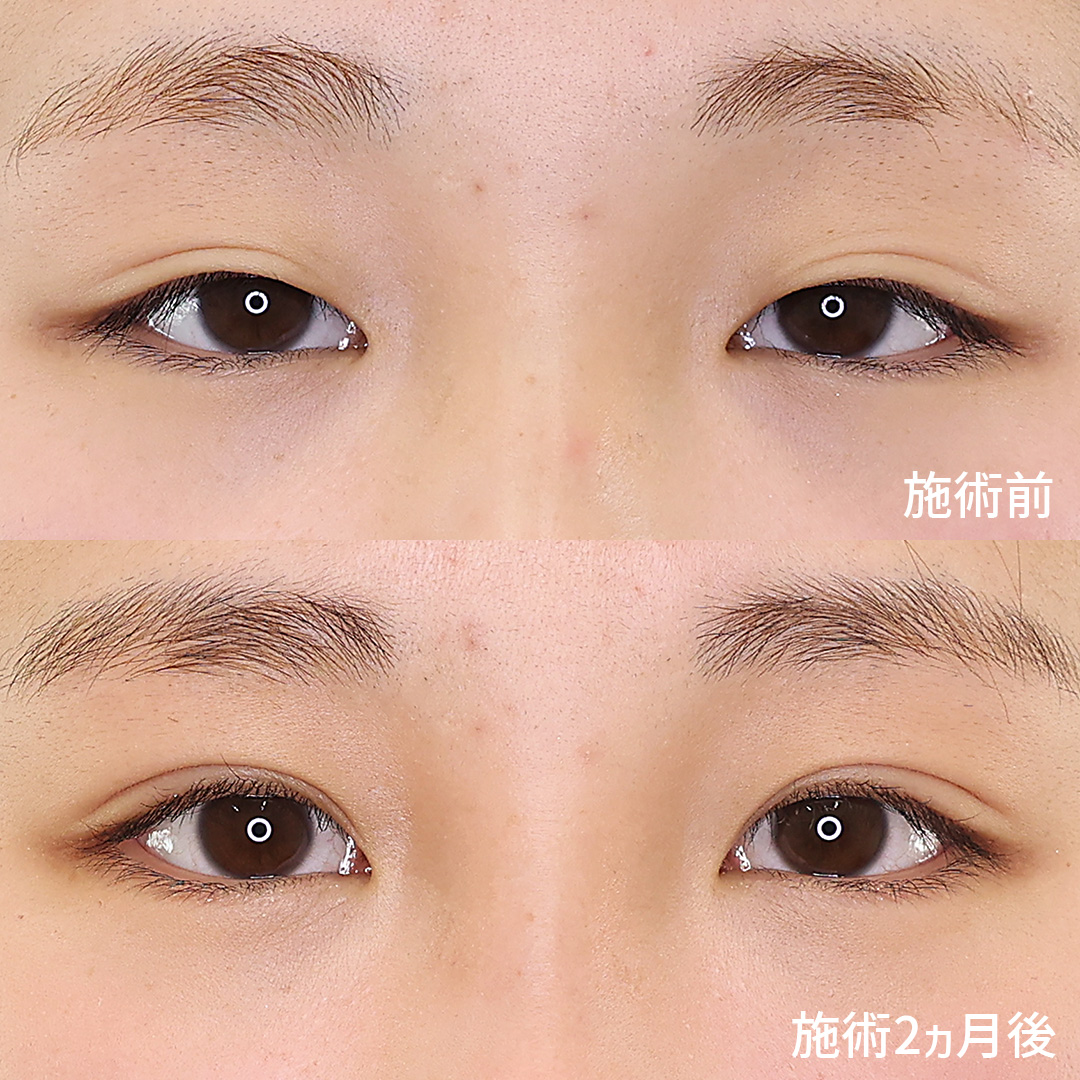 大人フェミニンな愛らしい目元へ。【二重埋没法】