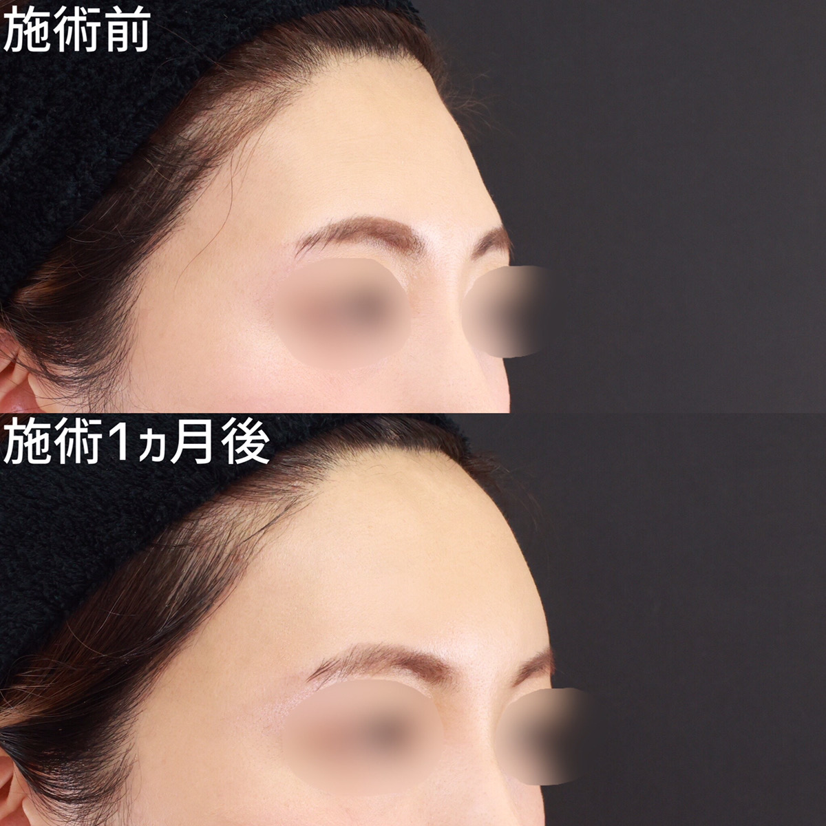 おでこの脂肪注入(オルチャンデコ形成)の症例写真 施術前後 1ヵ月
