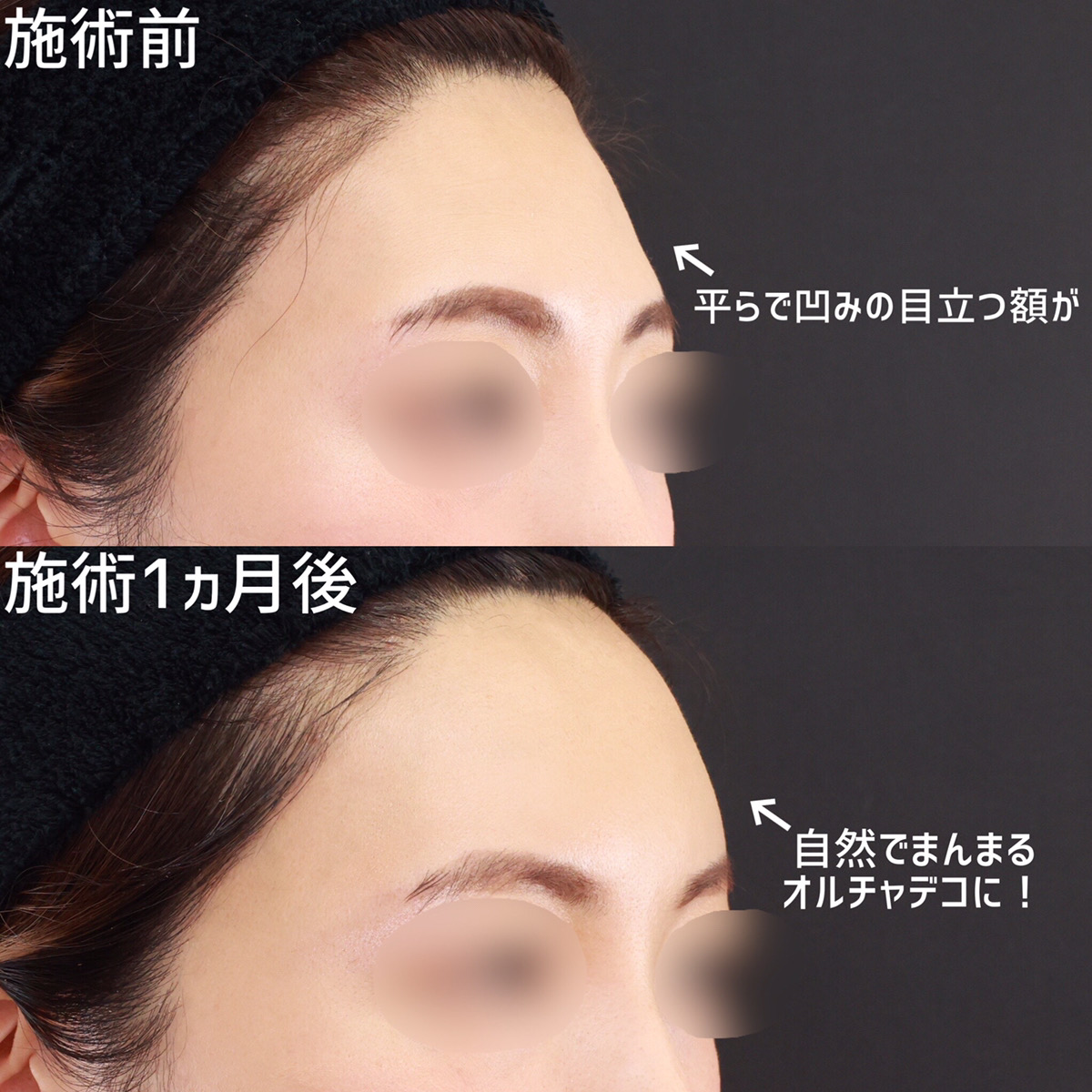 おでこの脂肪注入(オルチャンデコ形成)の症例写真 施術前後 1ヵ月