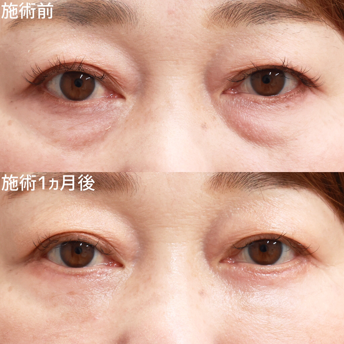 複合施術によりスッキリとした目元で若々しく