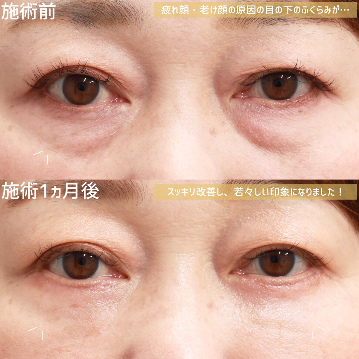 下眼瞼切開術（クマ・たるみとり）/下眼瞼脱脂術（目の下のたるみ取り・目の下の脂肪ふくらみ取り）/顔の脂肪注入(コンデンスリッチフェイス)の症例写真 施術前後 