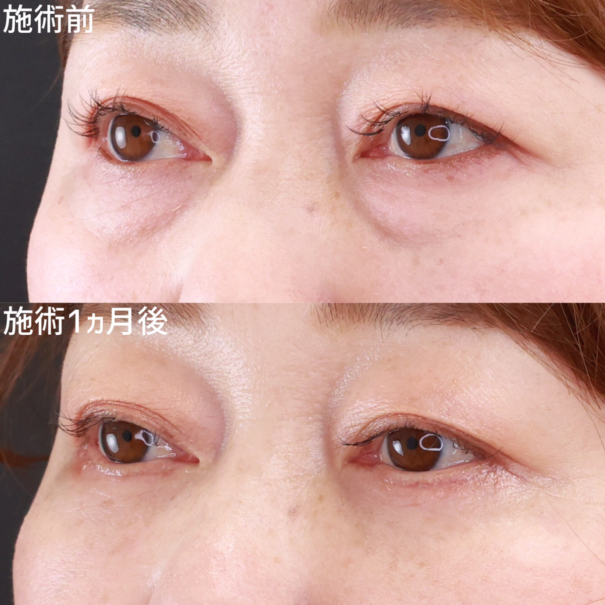下眼瞼切開術（クマ・たるみとり）/下眼瞼脱脂術（目の下のたるみ取り・目の下の脂肪ふくらみ取り）/顔の脂肪注入(コンデンスリッチフェイス)の症例写真 施術前後 