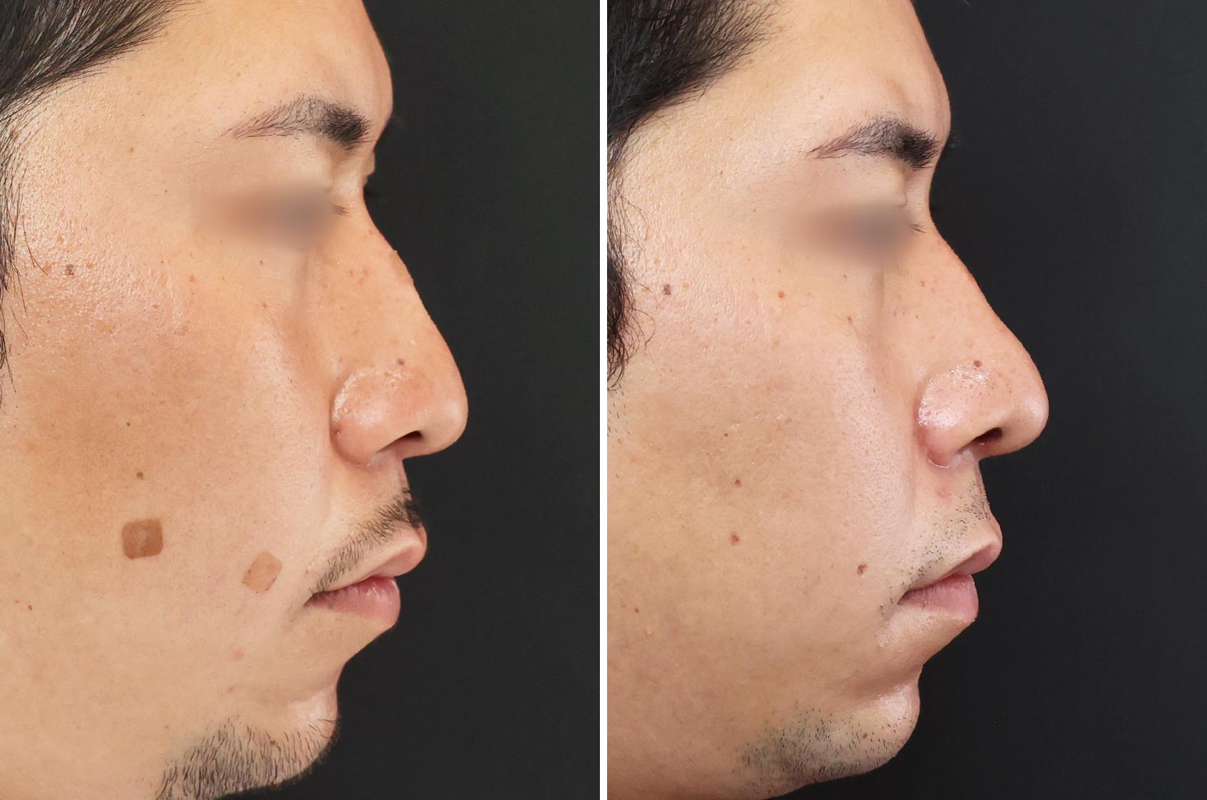 【シュッと】自然なノーズラインに