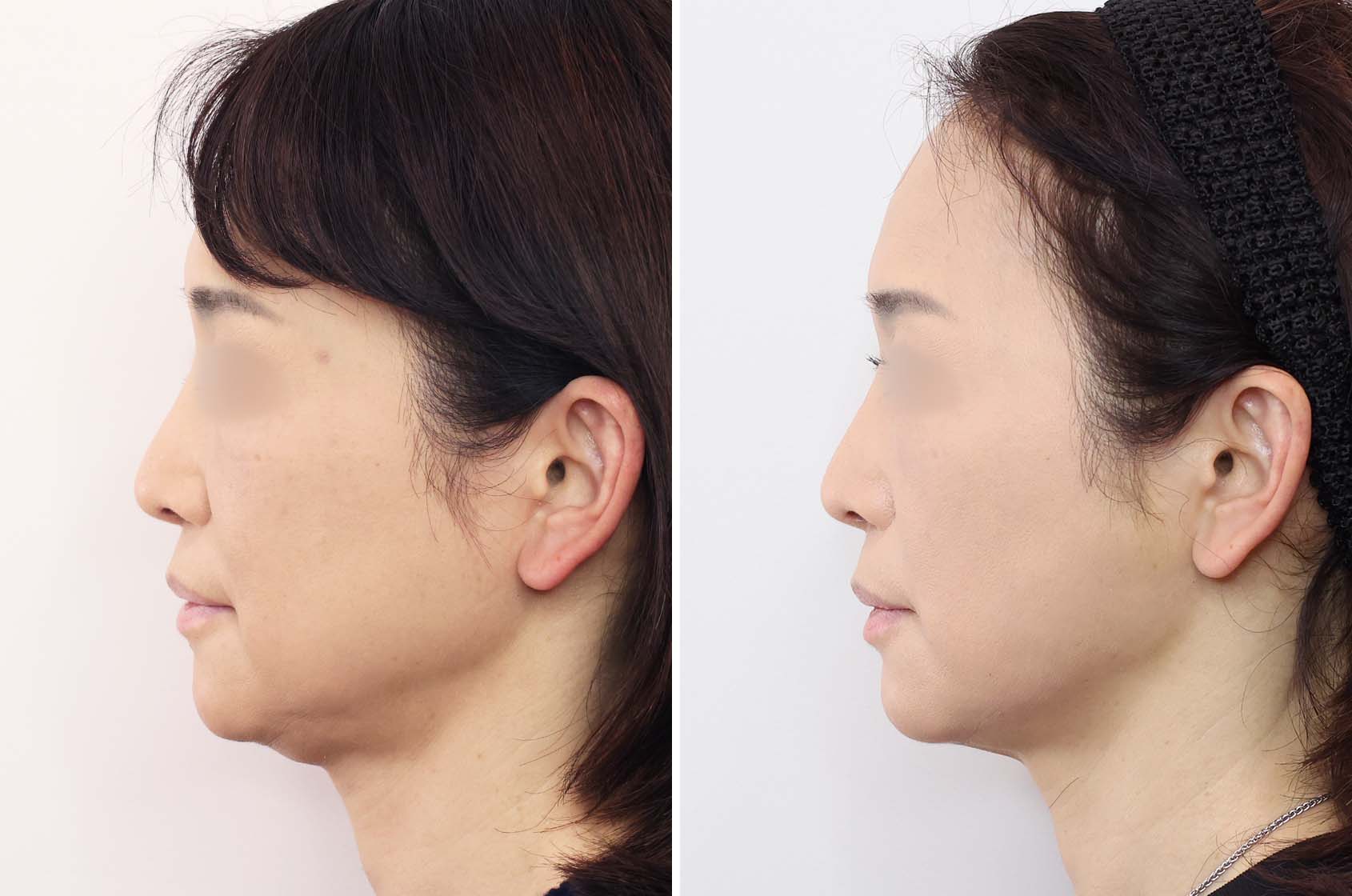 TAC式 ツヤ肌コラーゲンリフト®の症例写真 施術前後 １ヵ月