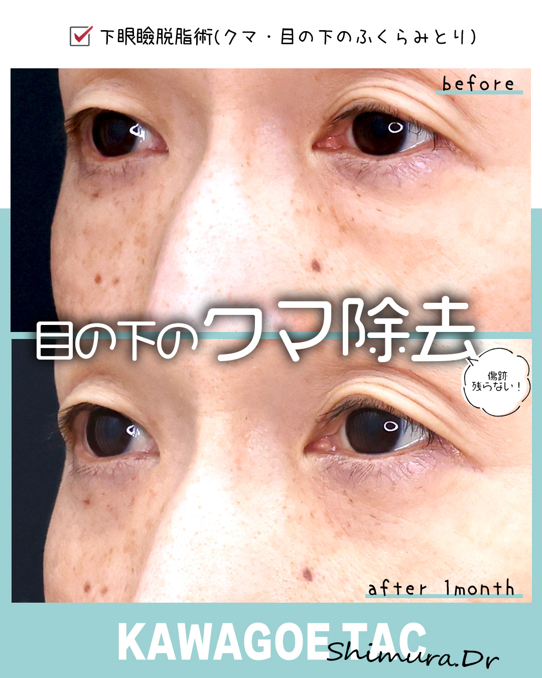 下眼瞼脱脂術（目の下のたるみ取り・目の下の脂肪ふくらみ取り）の症例写真 施術前後 