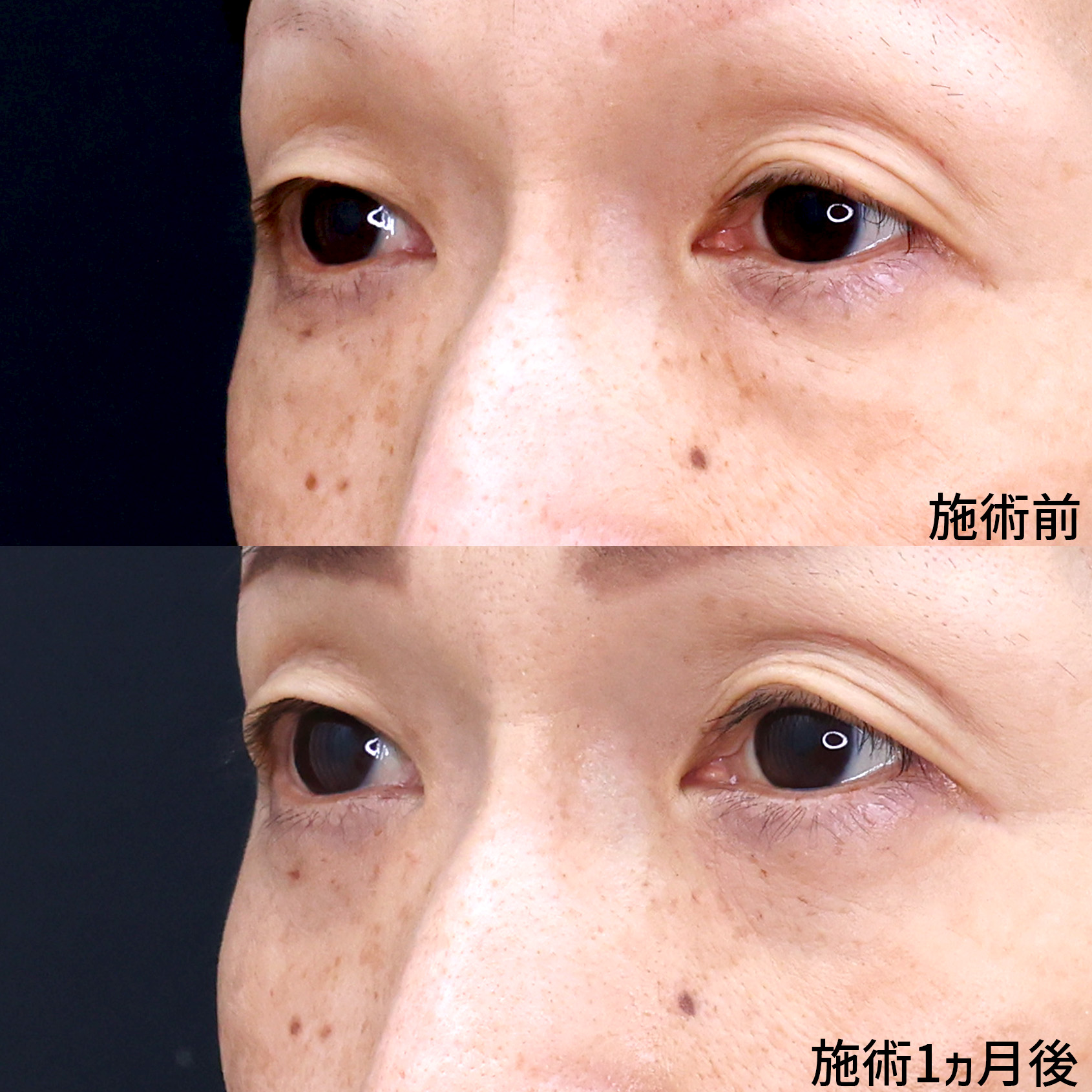 下眼瞼脱脂術で若々しいお目元へ