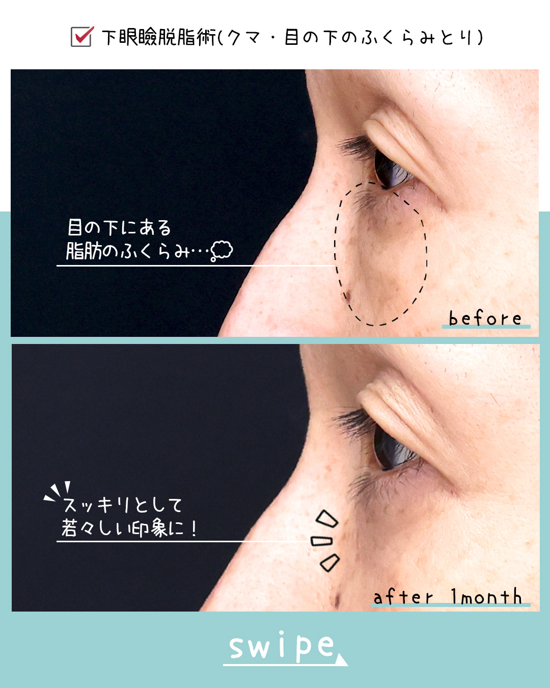 下眼瞼脱脂術（目の下のたるみ取り・目の下の脂肪ふくらみ取り）の症例写真 施術前後 