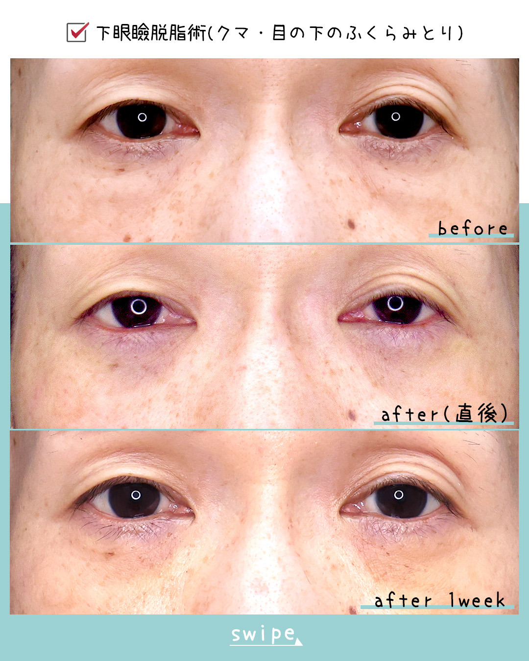 下眼瞼脱脂術（目の下のたるみ取り・目の下の脂肪ふくらみ取り）の症例写真 施術前後 