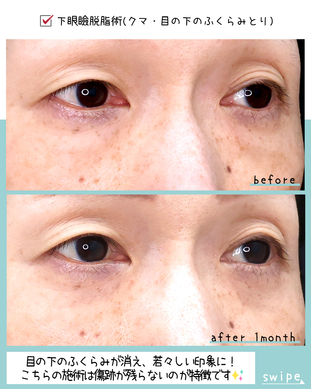 下眼瞼脱脂術（目の下のたるみ取り・目の下の脂肪ふくらみ取り）の症例写真 施術前後 