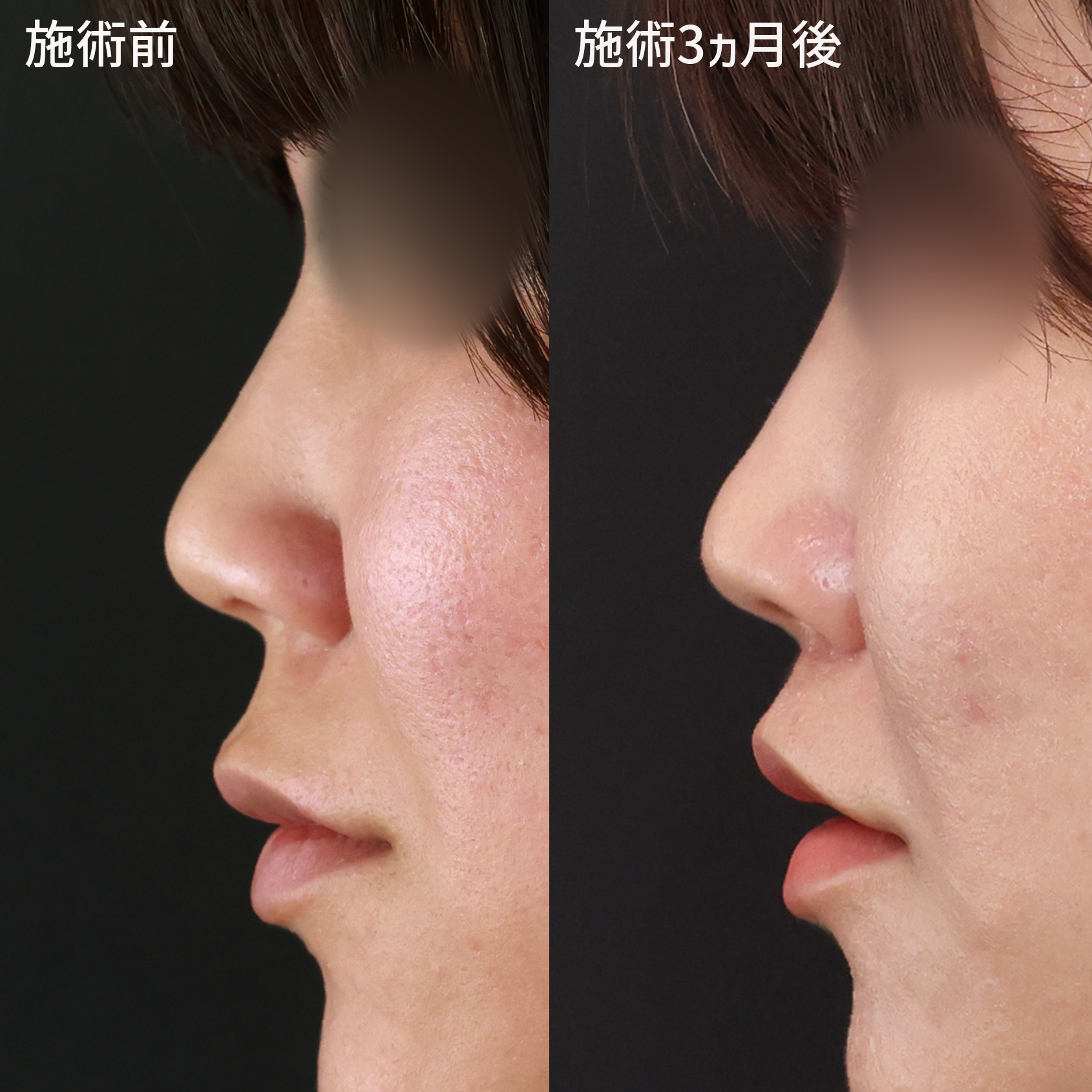 人中短縮術(リップリフト)・外側人中短縮術/はちみつ注射(WSC-PRP)の症例写真 施術前後