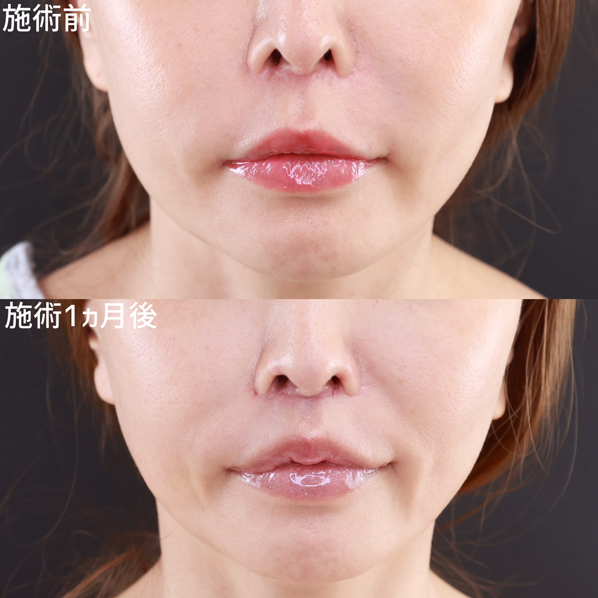 人中短縮術(リップリフト)・外側人中短縮術/鼻孔縁下降術/M字リップ形成術の症例写真 施術前後