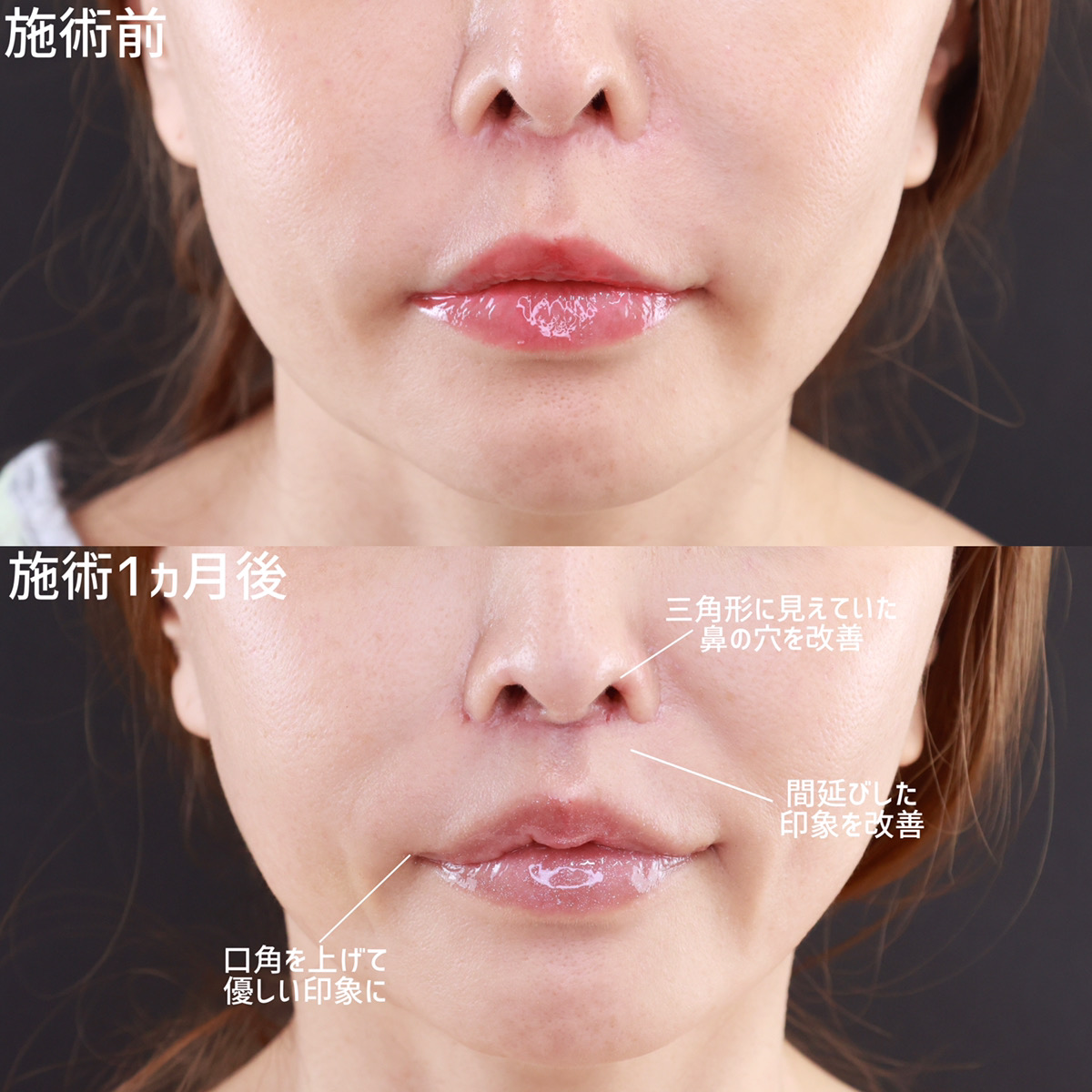 人中短縮術(リップリフト)・外側人中短縮術/鼻孔縁下降術/M字リップ形成術の症例写真 施術前後