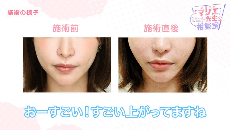 糸リフトの施術前と施術直後の正面の顔を並べた比較画面