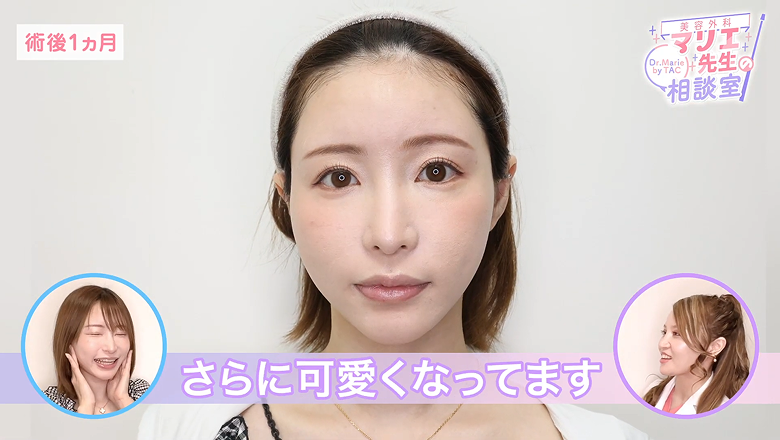 施術1カ月後の天使もえさんの顔を正面から映した場面
