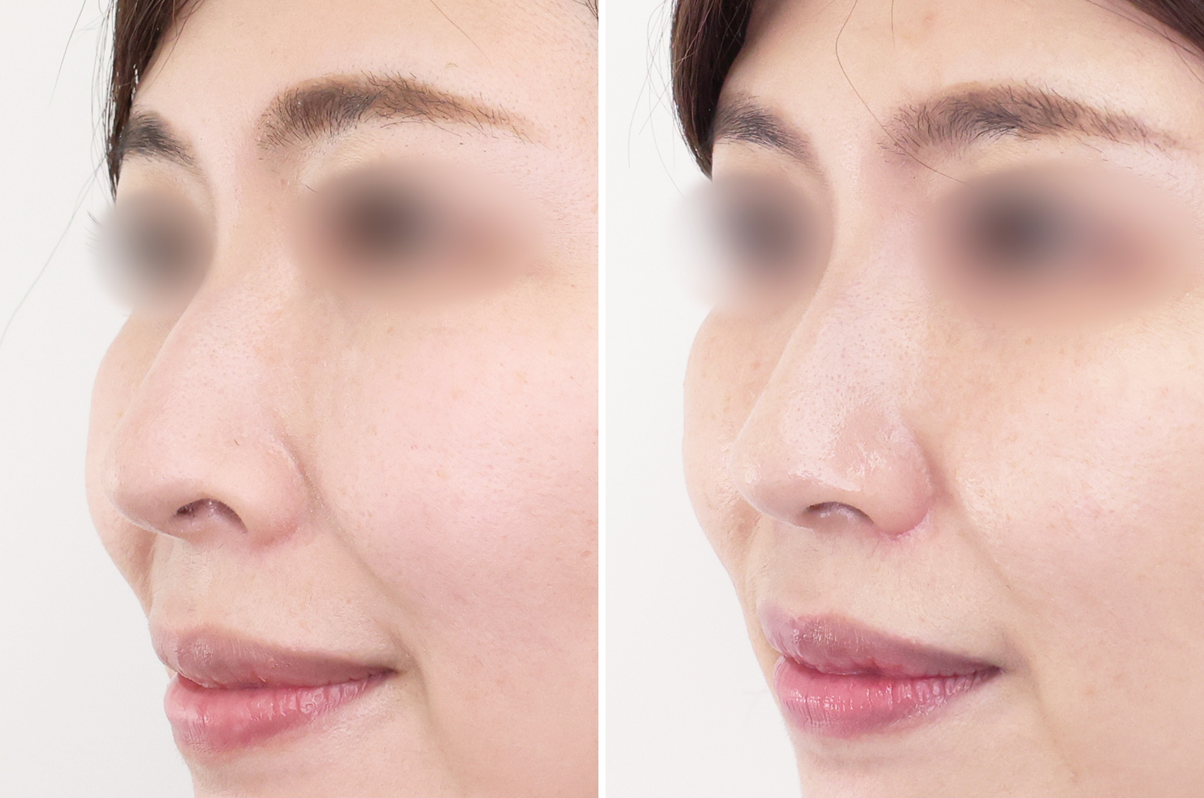 もう鼻の穴を気にしない！鼻孔縁下降術×鼻翼挙上術の合わせ技で美人鼻に