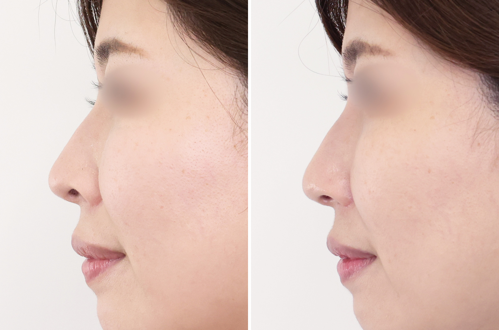鼻孔縁下降術/鼻翼挙上術の症例写真 施術前後 3ヵ月