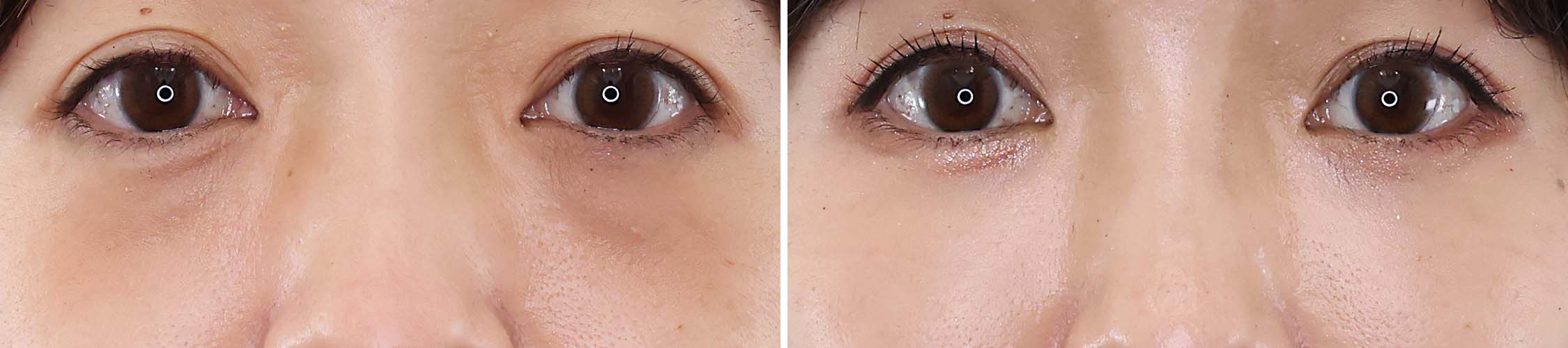 【下眼瞼脱脂術】と【脂肪注入】で目の下のお悩みを解決して健康的な印象に。