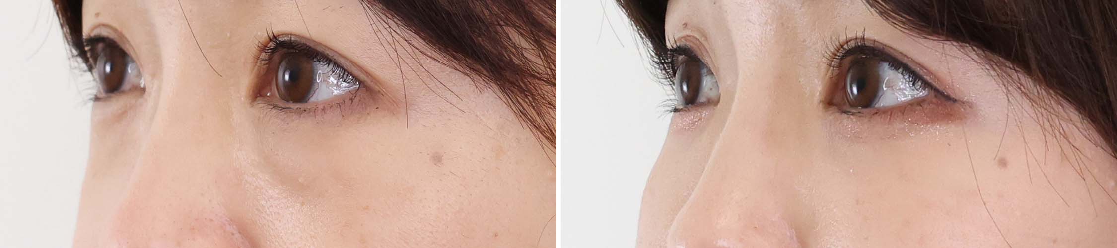 下眼瞼脱脂術（目の下のたるみ取り・目の下の脂肪ふくらみ取り）/顔の脂肪注入(コンデンスリッチフェイス)の症例写真 施術前後 1ヵ月