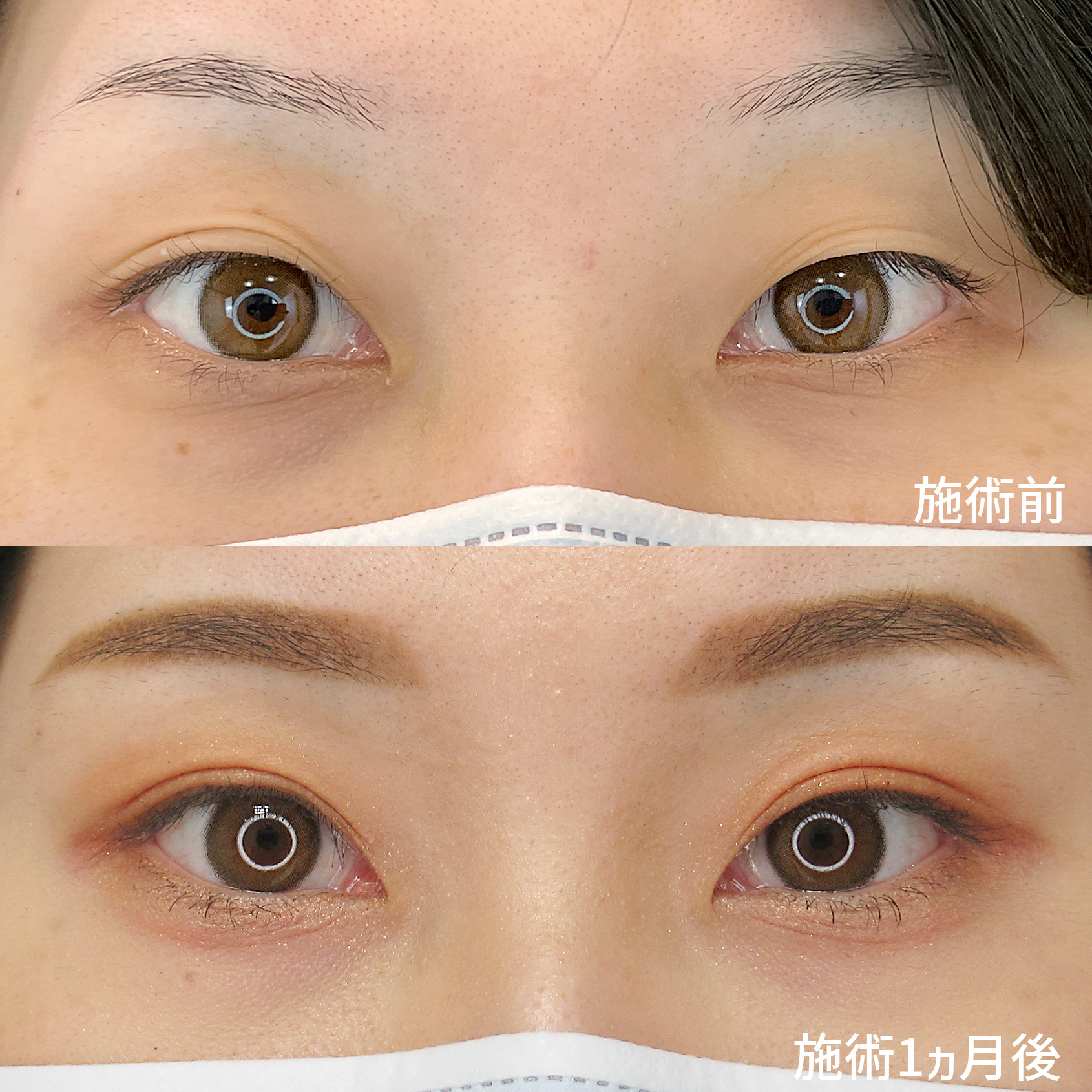 不揃いから美しいMix型二重へアップデート！左右差を整える為のお手軽二重術。