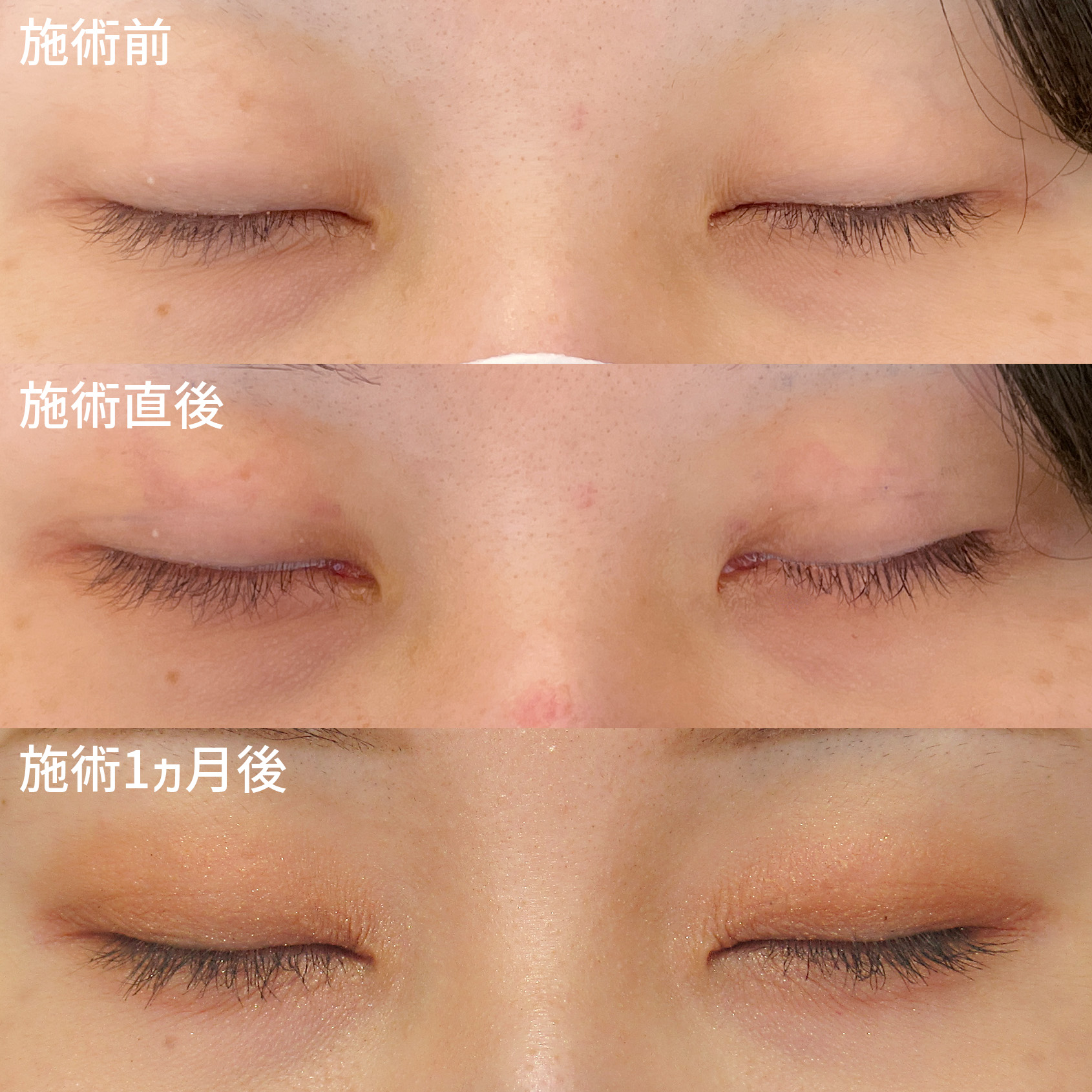 二重埋没法の症例写真 施術前後 