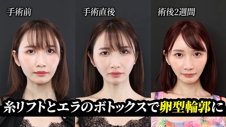 糸リフトとエラボトックス施術前・直後・術後2週間の経過比較