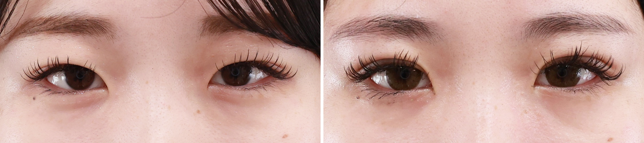 【TAC式二重埋没法】二重幅を広げて、理想のMIX二重に