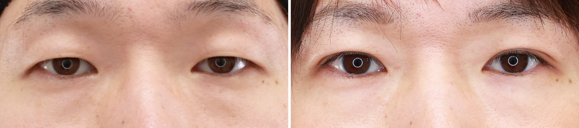 TAC式二重埋没法で重たい印象の目元を変える