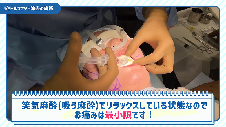 笑気麻酔を使いながらジョールファット除去を進める様子