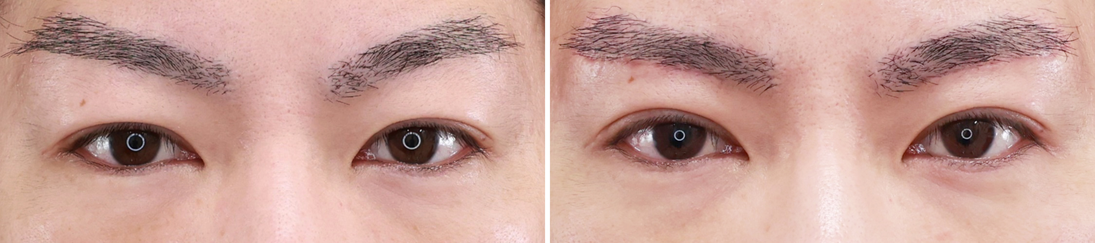 眉毛下切開術の症例写真 施術前後 １ヵ月