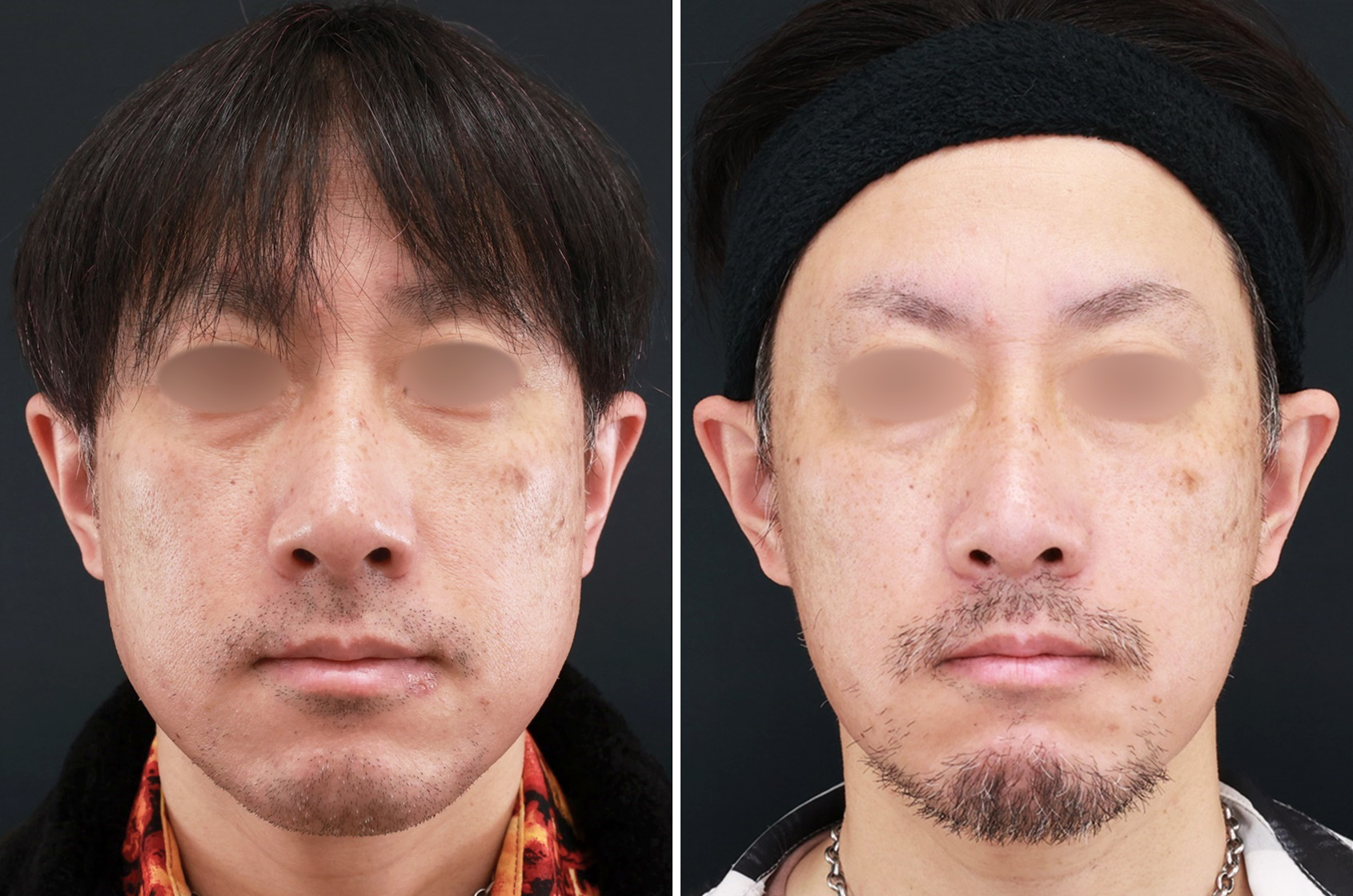 【糸リフト×脂肪除去】たるみ改善で若々しい印象に