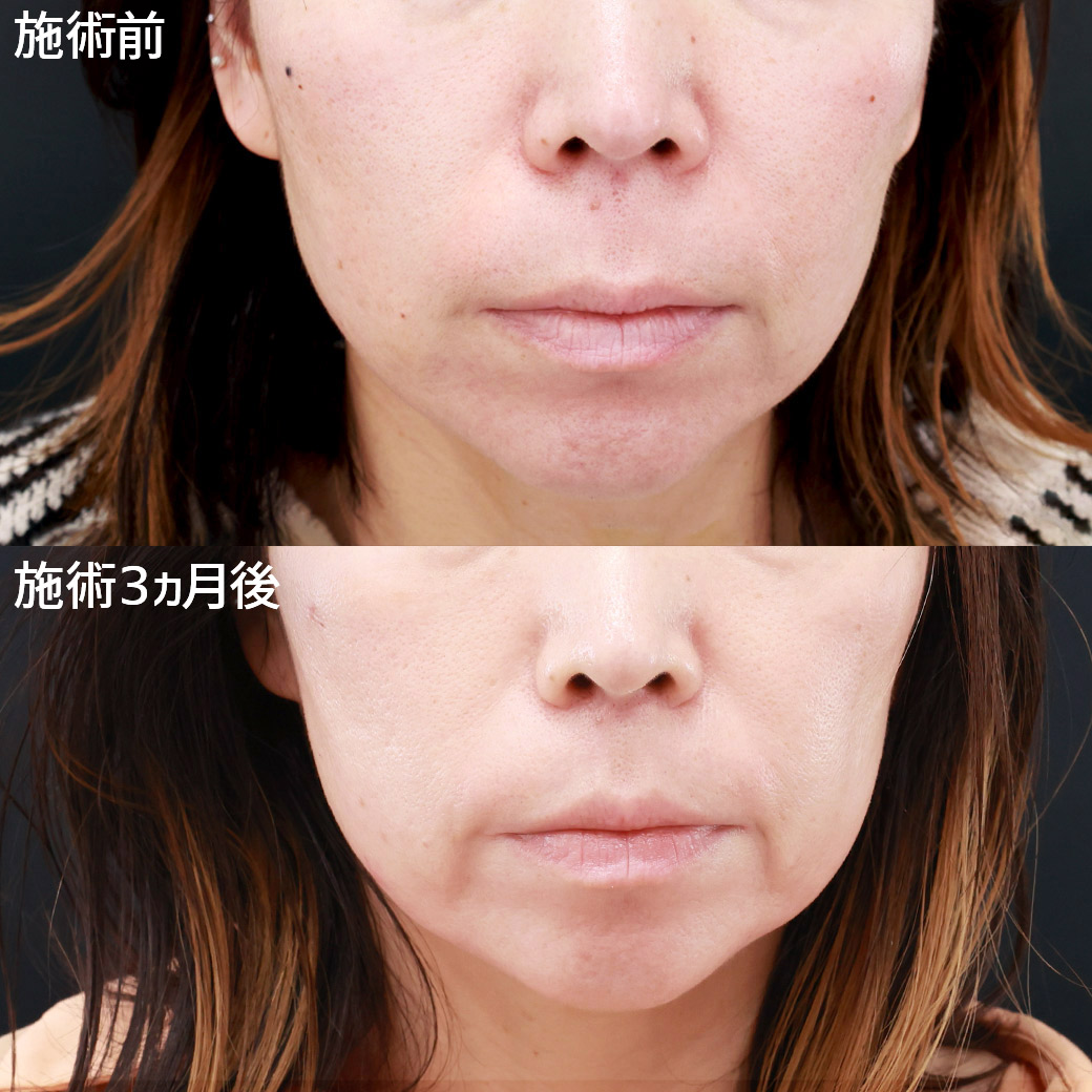 人中短縮術で間延びした印象を改善