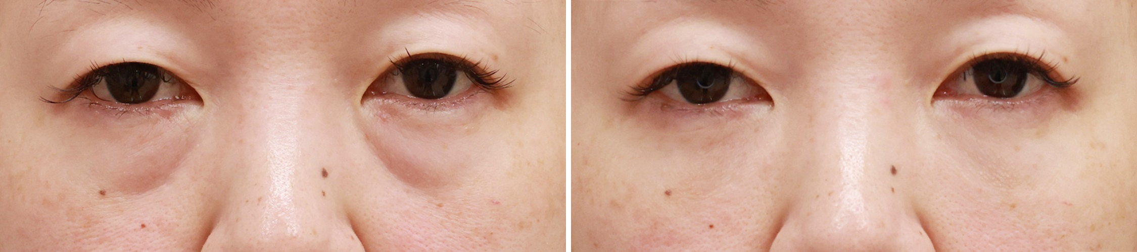 加齢とともに目立ってくる目の下のクマに【下眼瞼脱脂術＆脂肪注入】