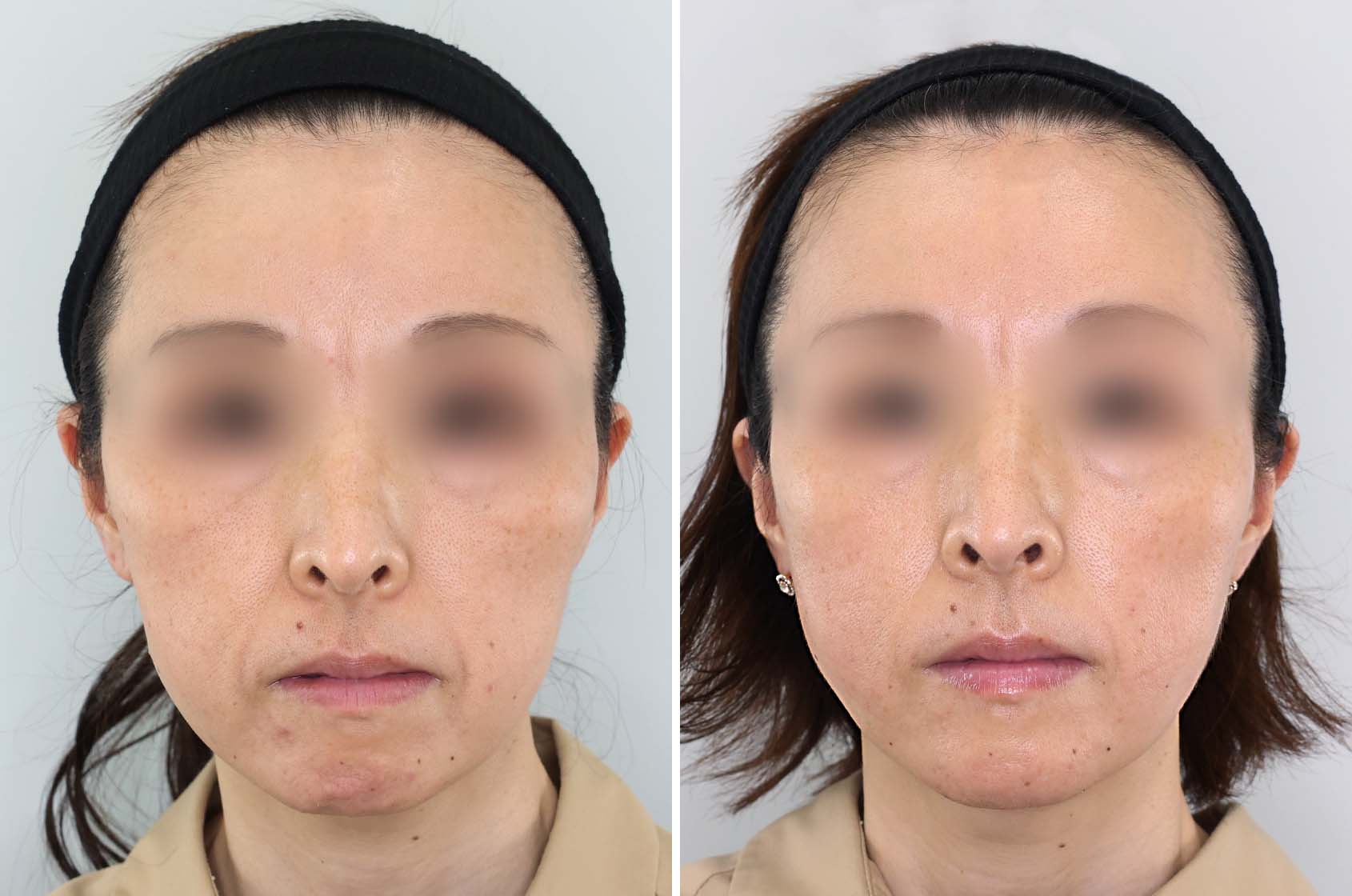 若見え、小顔効果を実感したい方にお薦めの脂肪除去とリフトアップの組み合わせ。