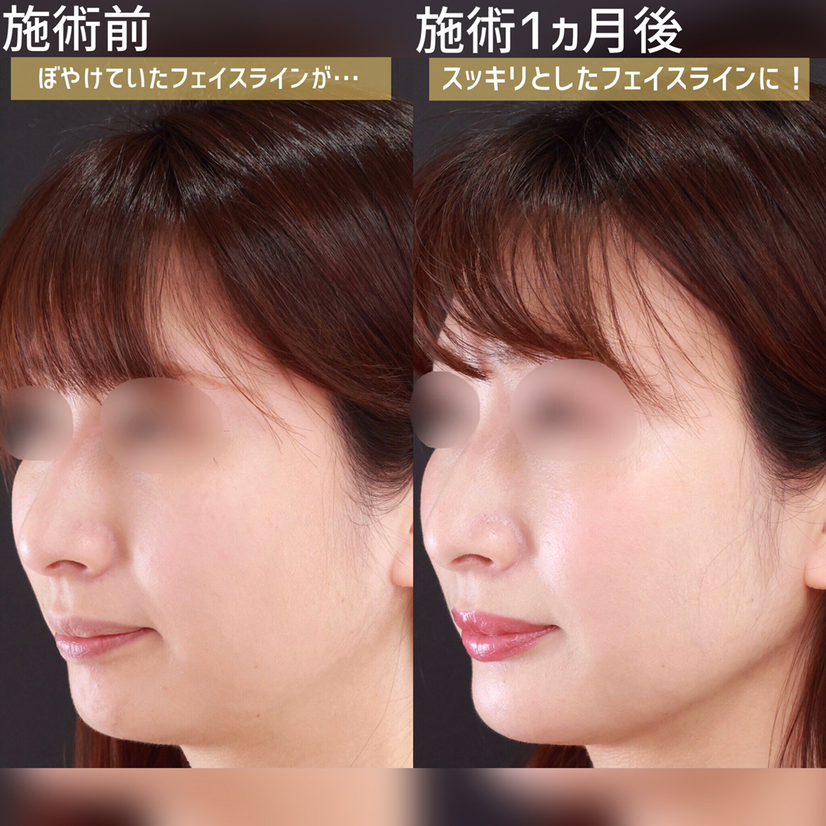 顔の脂肪吸引/顎のヒアルロン酸注射の症例写真 施術前後 