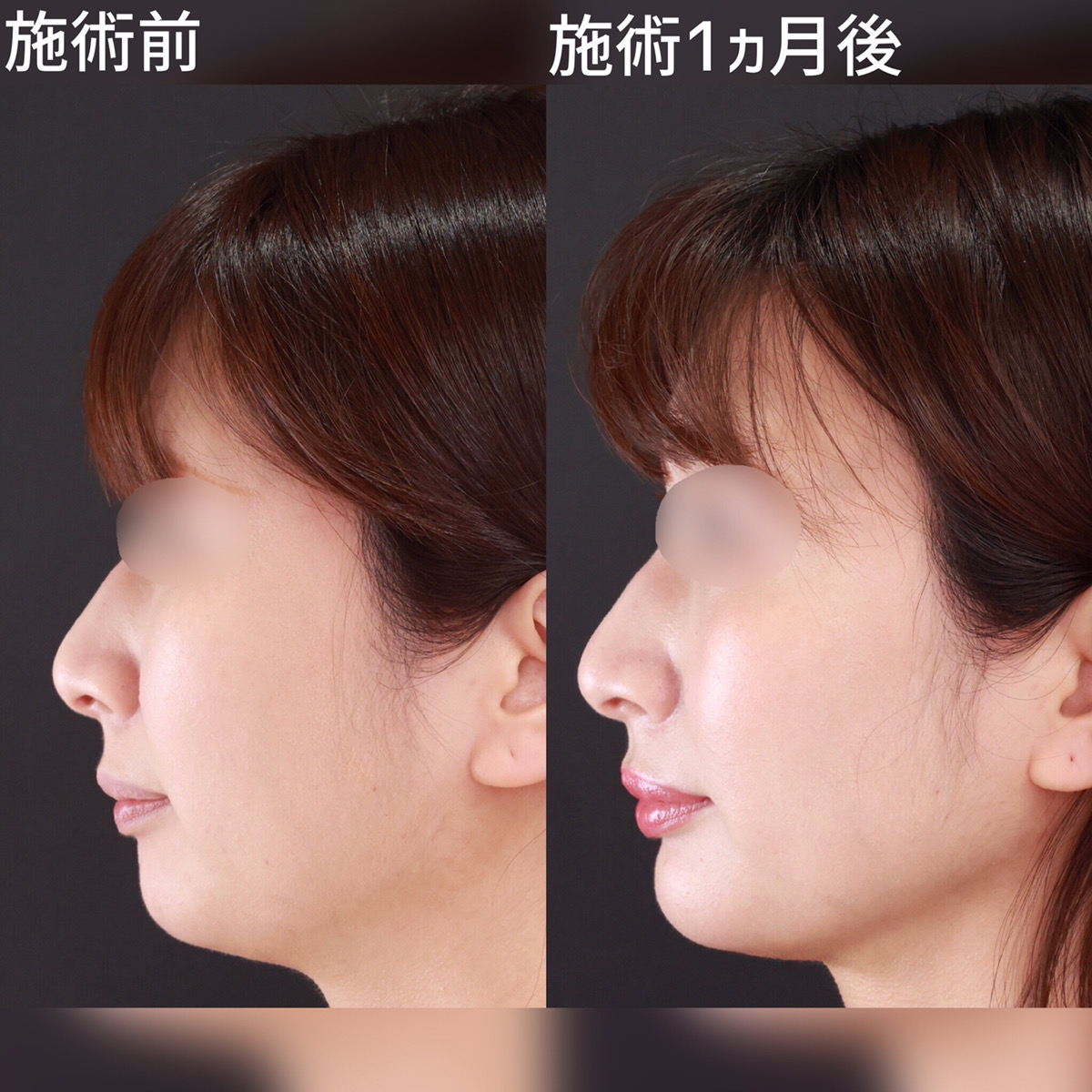 顔の脂肪吸引/顎のヒアルロン酸注射の症例写真 施術前後 １ヵ月