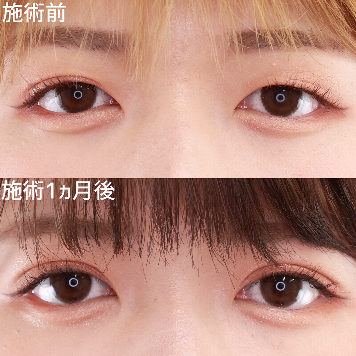 二重埋没法の症例写真 施術前後