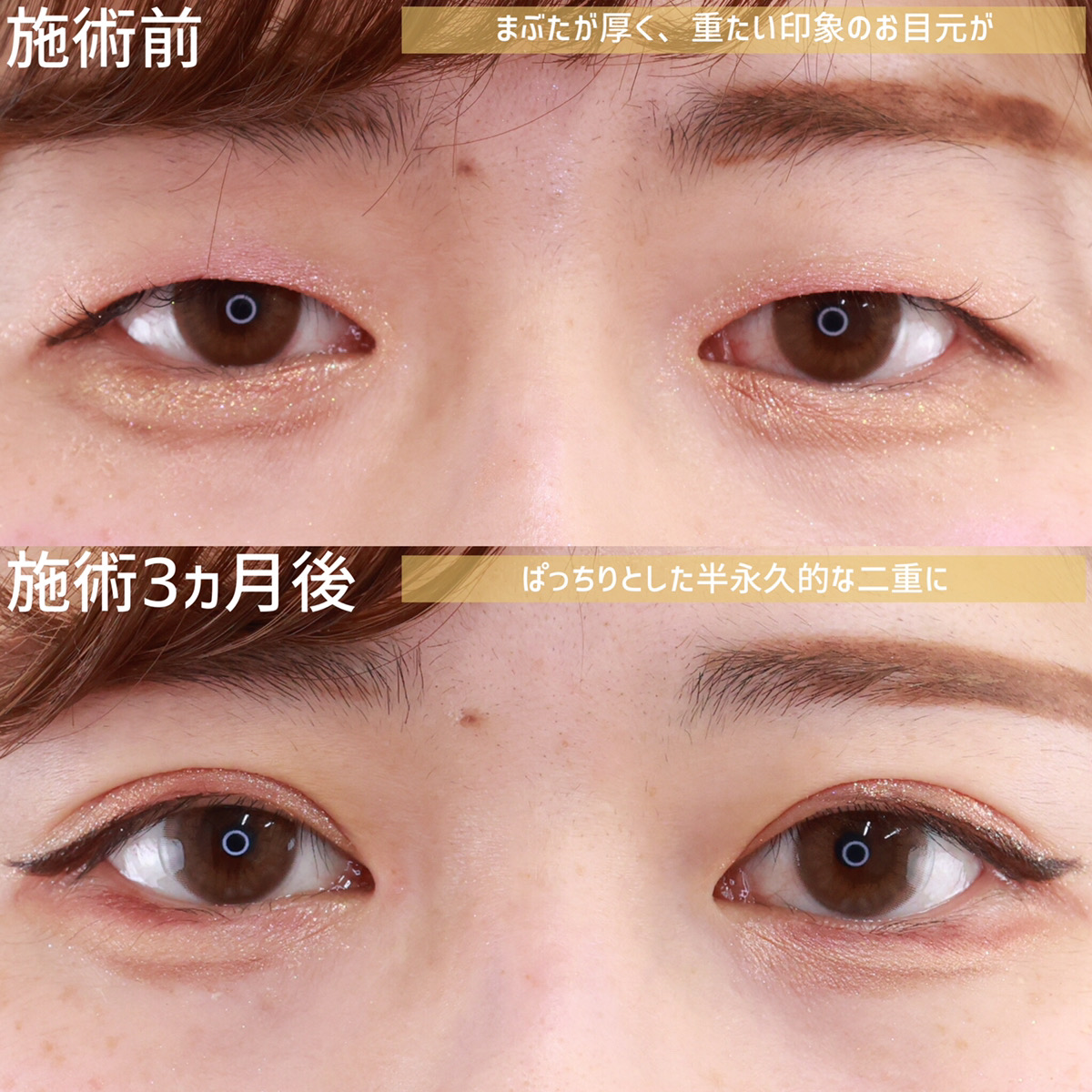 上眼瞼切開術/目元：その他の症例写真 施術前後 