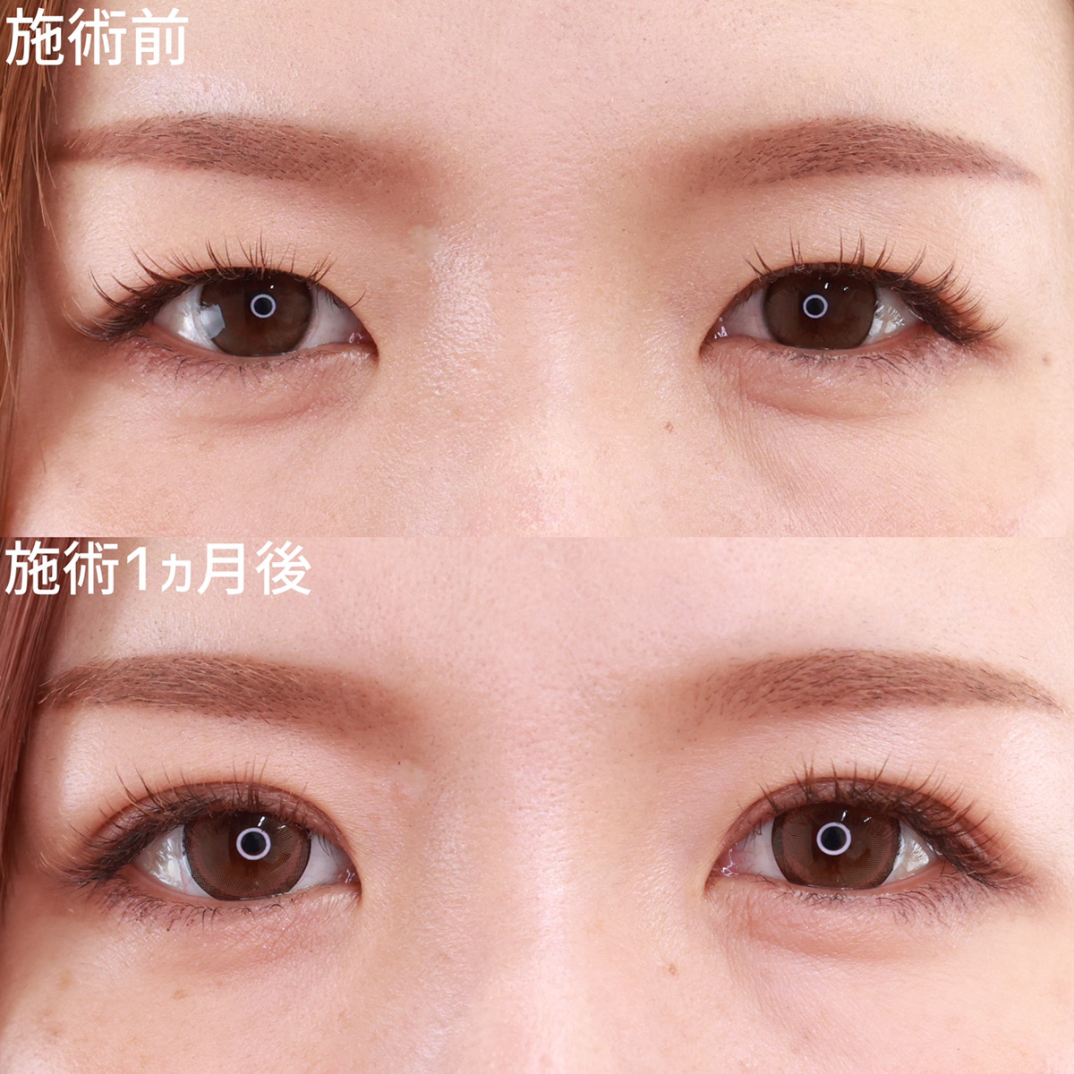 二重埋没法/目元:その他の症例写真 施術前後