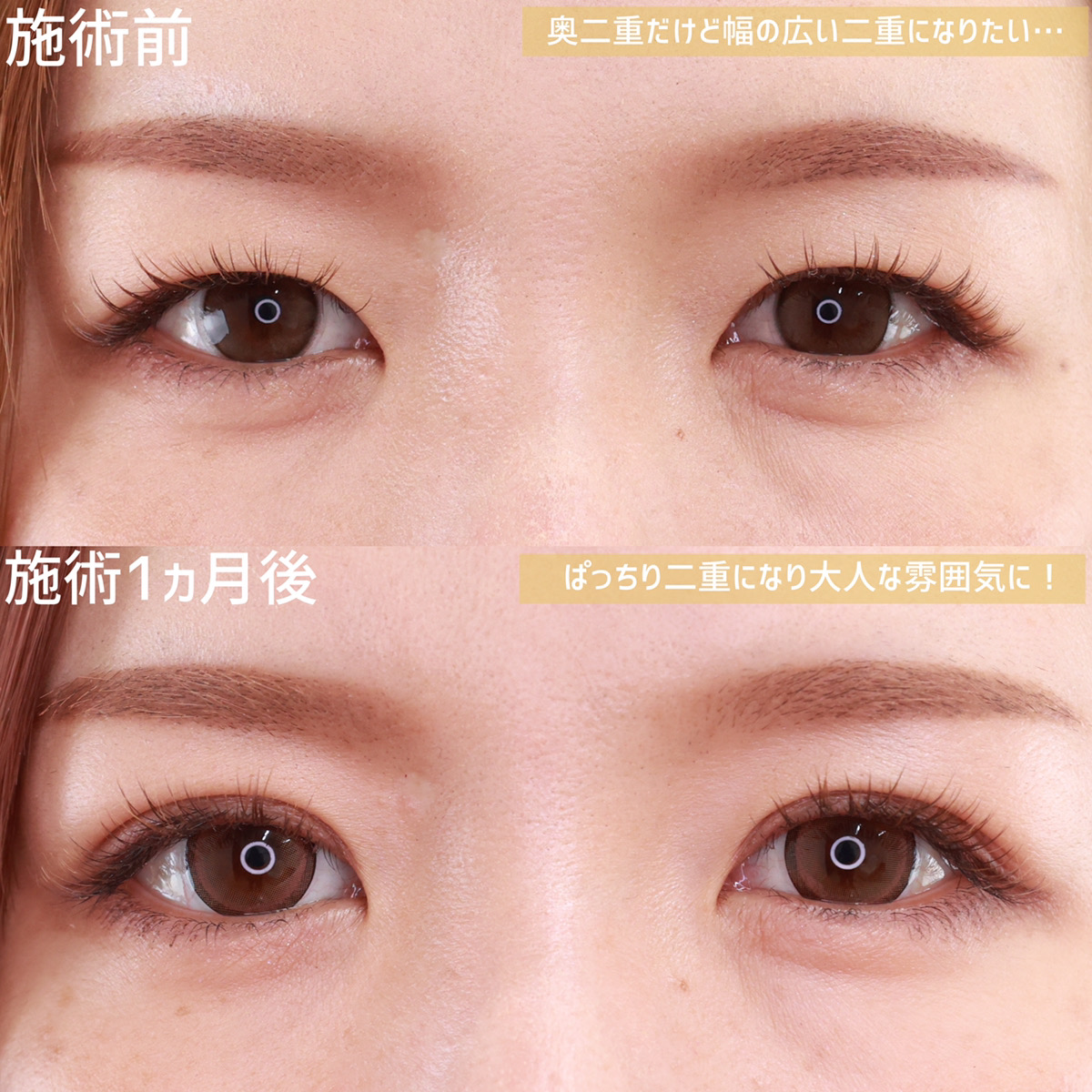 二重埋没法/目元:その他の症例写真 施術前後