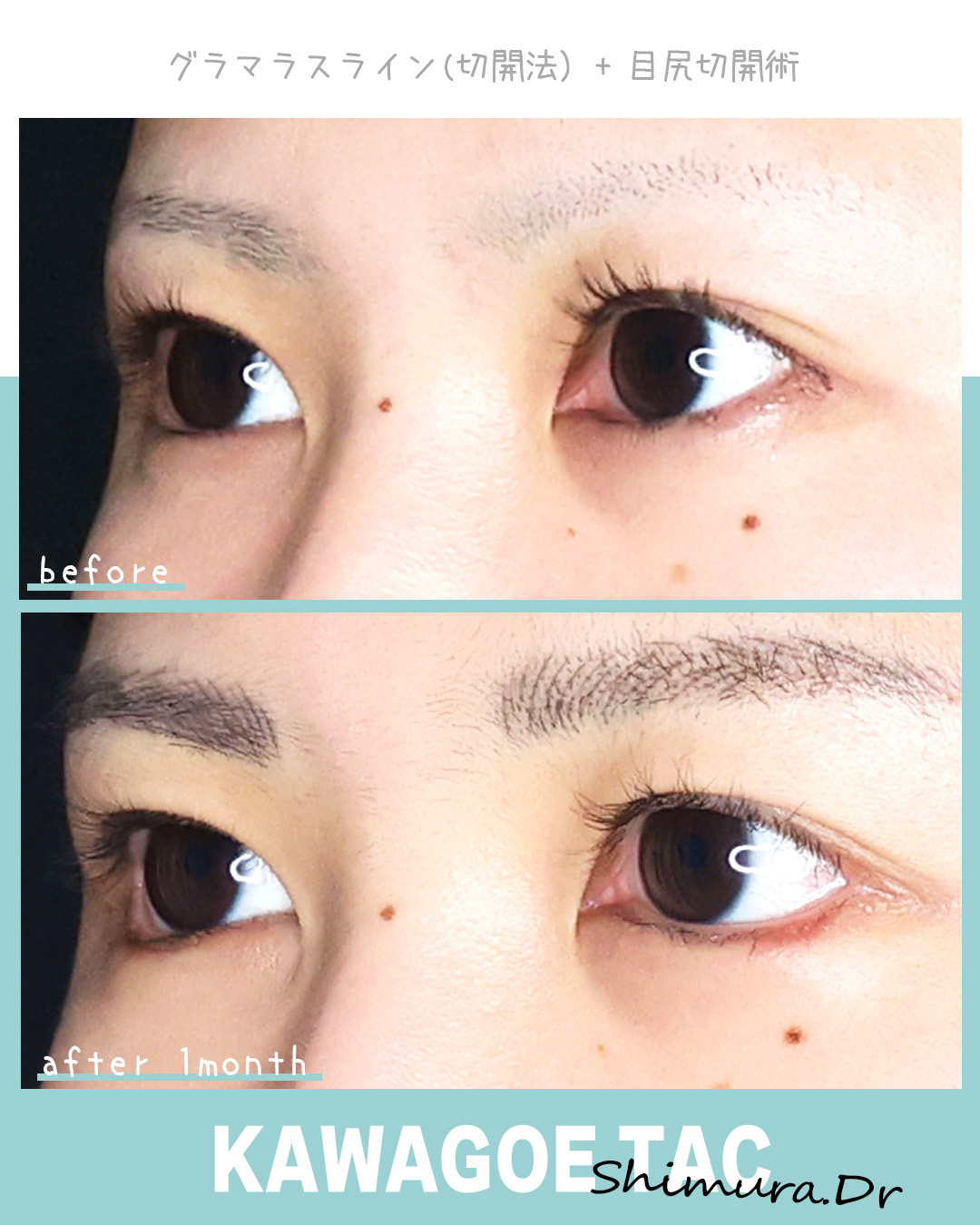 グラマラスライン（タレ目形成）の症例写真 施術前後 