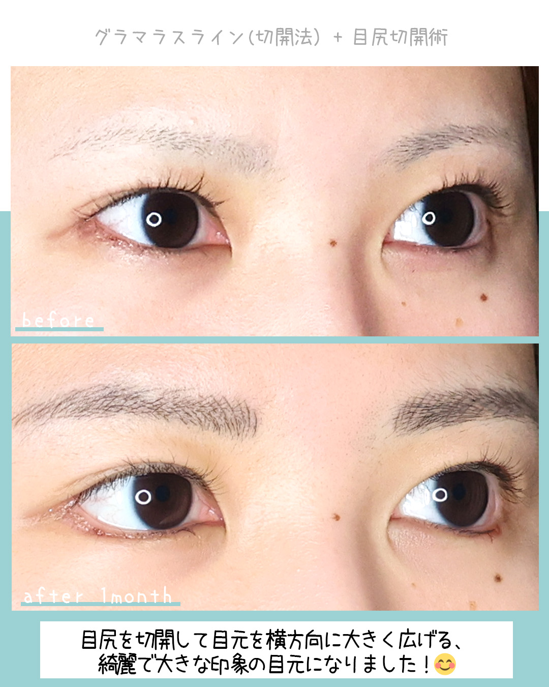 グラマラスライン（タレ目形成）の症例写真 施術前後 