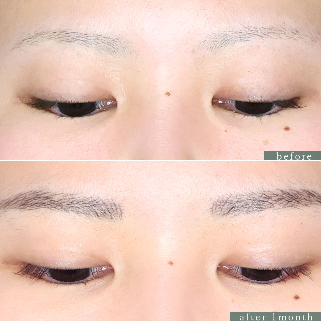 グラマラスライン（タレ目形成）の症例写真 施術前後 