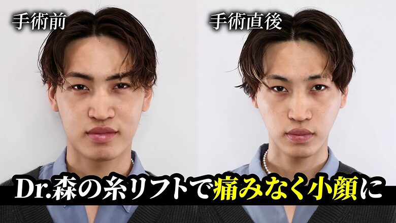 糸リフトの施術前と施術直後を比較した渡辺龍星さん