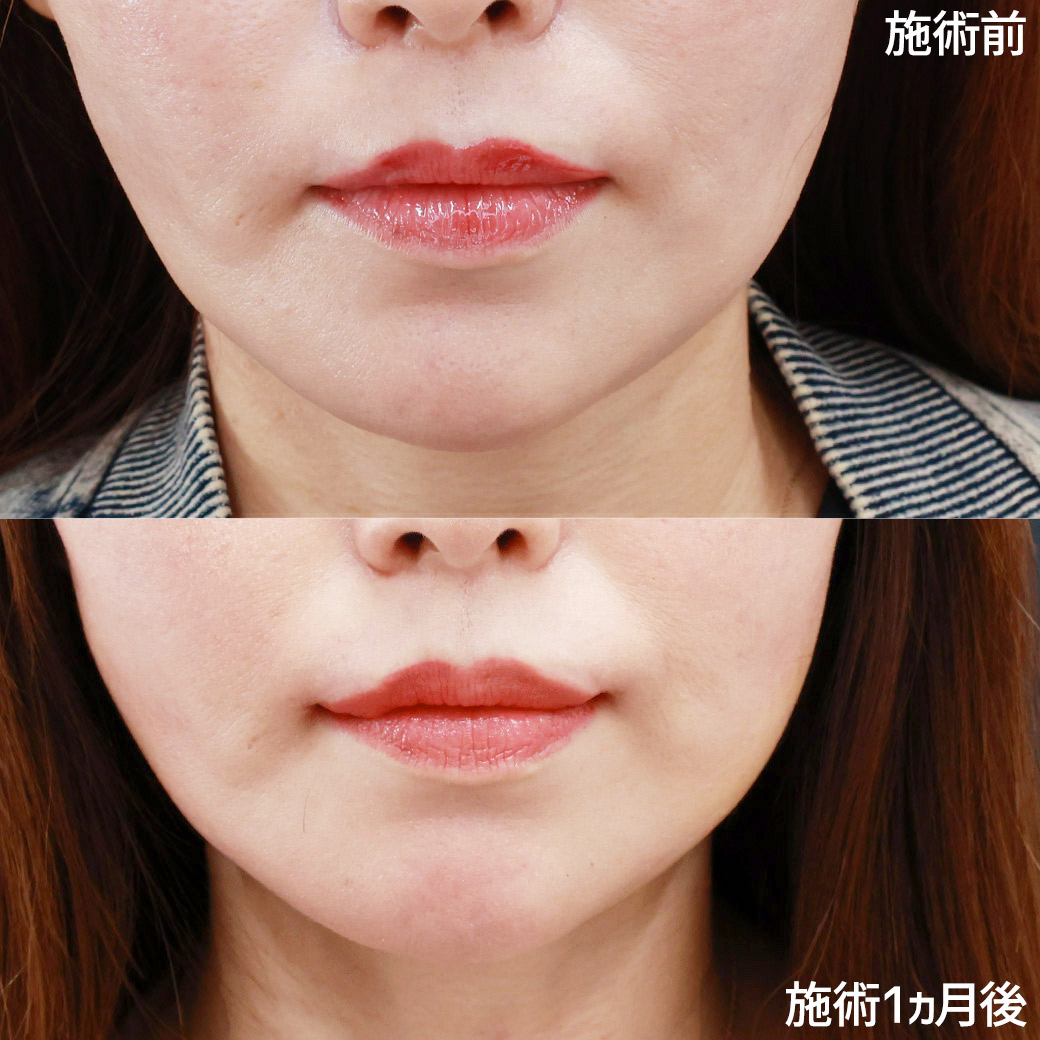 傷跡が気になる方におススメの口角挙上【内側法・口内法】