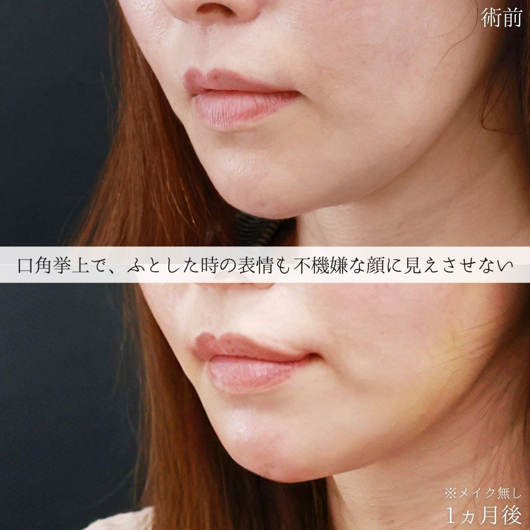 口角挙上・リフト（マイクロ切開法・内側法/口内法）の症例写真 施術前後 