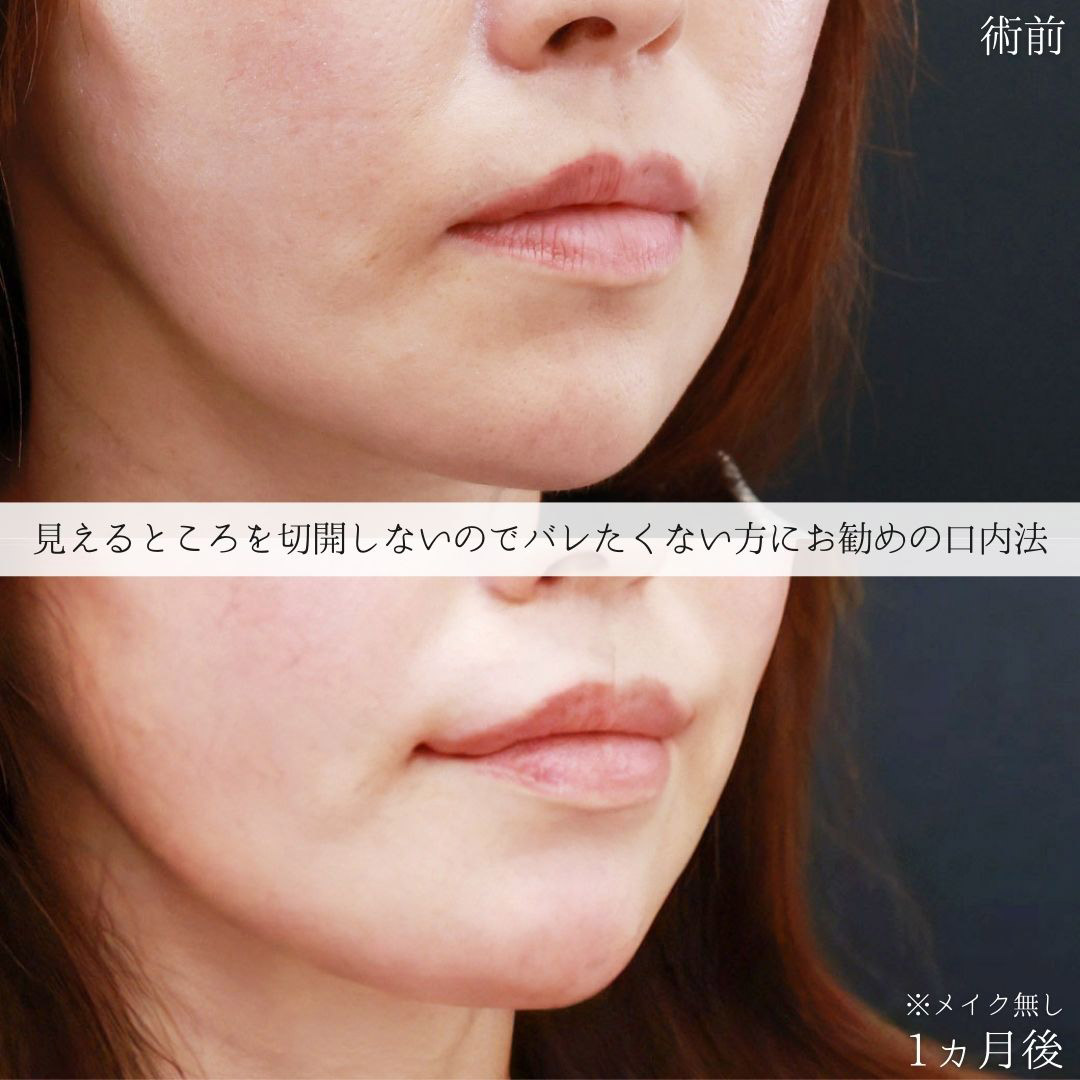 口角挙上・リフト（マイクロ切開法・内側法/口内法）の症例写真 施術前後 
