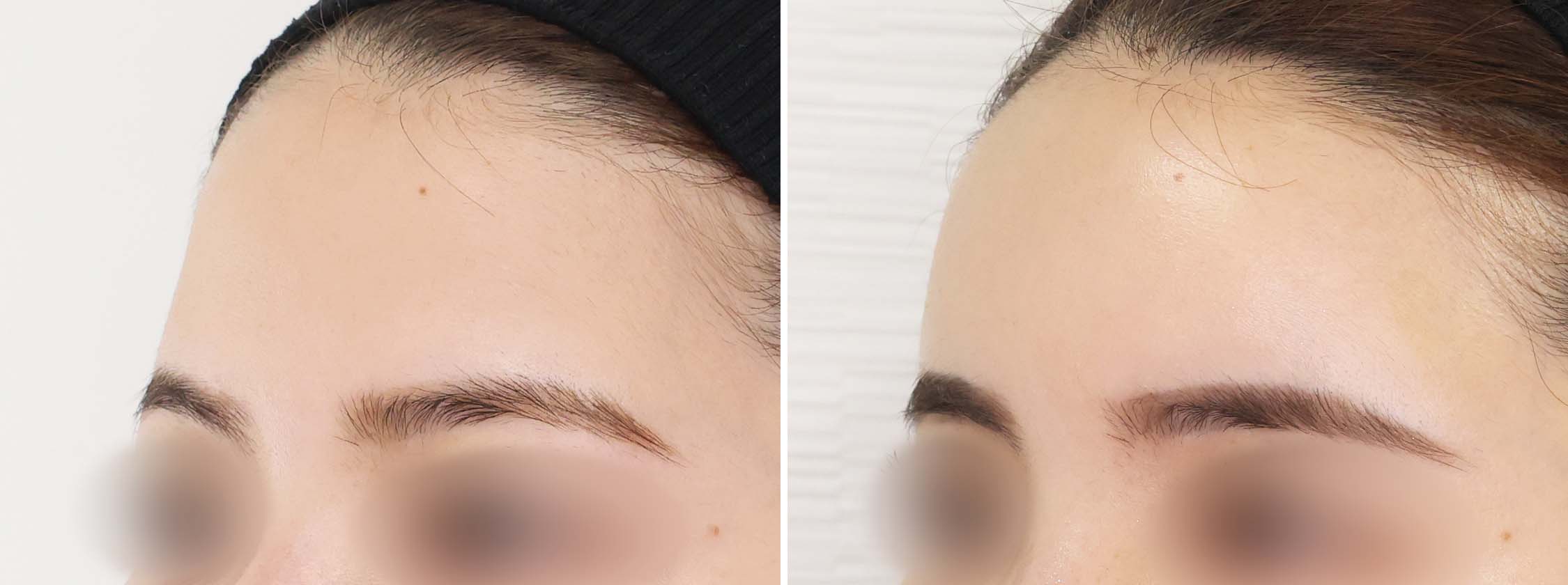 顔の脂肪注入(コンデンスリッチフェイス)の症例写真 施術前後 1週間