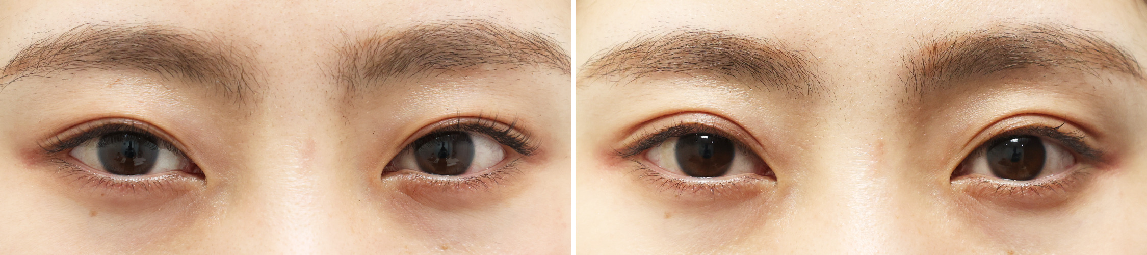 【クイックコスメリング】目元の印象度が格段にアップした！ナチュラルな幅広二重！！